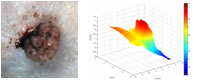 3D computer vision carcinoma